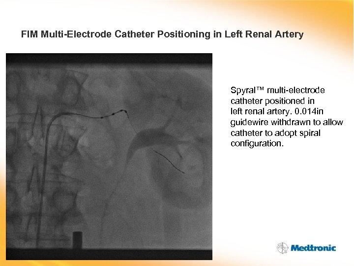FIM Multi-Electrode Catheter Positioning in Left Renal Artery Spyral™ multi-electrode catheter positioned in left