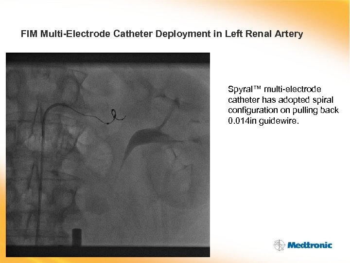 FIM Multi-Electrode Catheter Deployment in Left Renal Artery Spyral™ multi-electrode catheter has adopted spiral