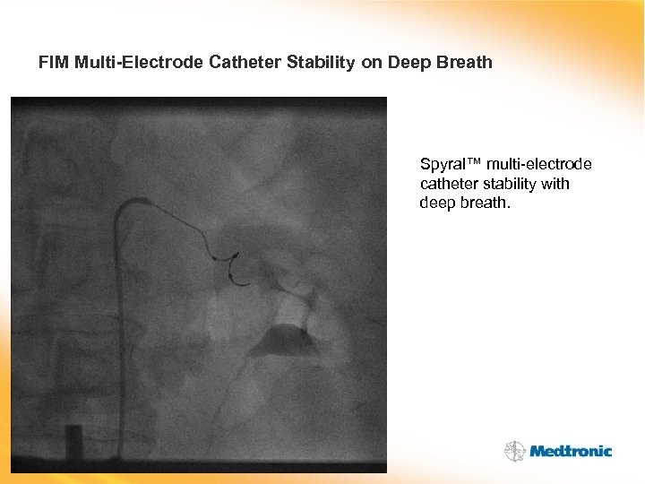 FIM Multi-Electrode Catheter Stability on Deep Breath Spyral™ multi-electrode catheter stability with deep breath.