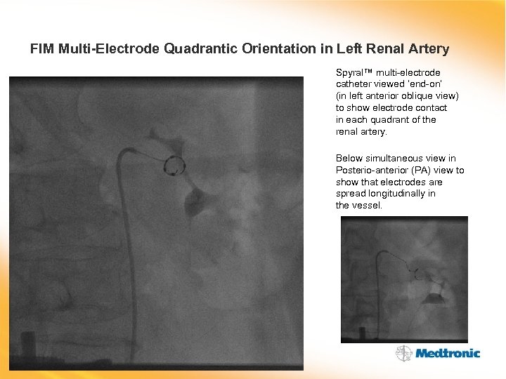 FIM Multi-Electrode Quadrantic Orientation in Left Renal Artery Spyral™ multi-electrode catheter viewed ‘end-on’ (in