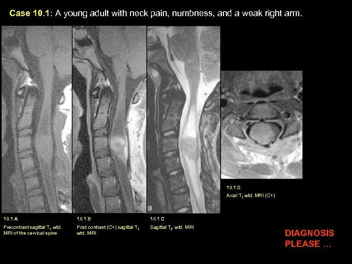 Case 10. 1: A young adult with neck pain, numbness, and a weak right
