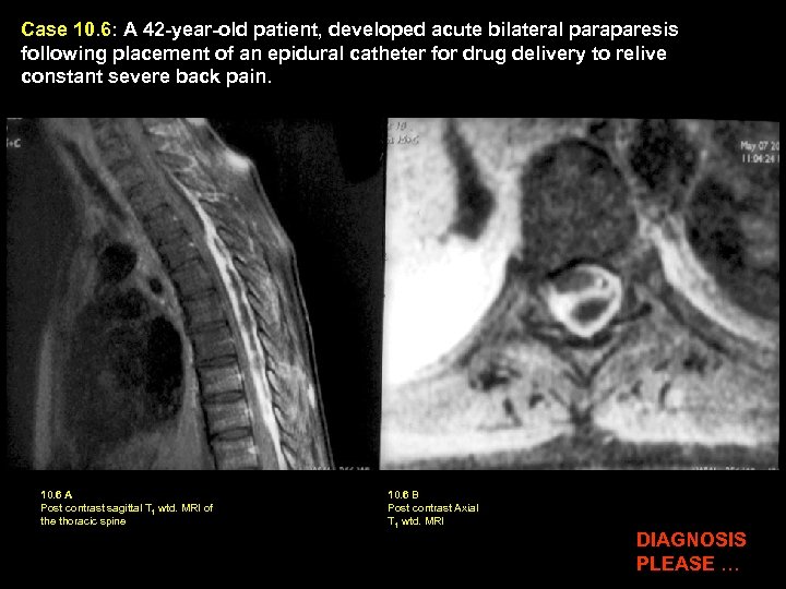 Case 10. 6: A 42 -year-old patient, developed acute bilateral paraparesis following placement of