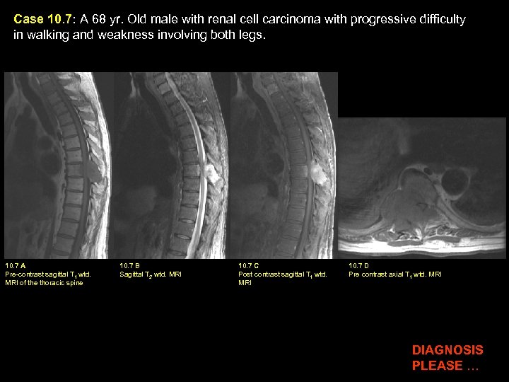 Case 10. 7: A 68 yr. Old male with renal cell carcinoma with progressive