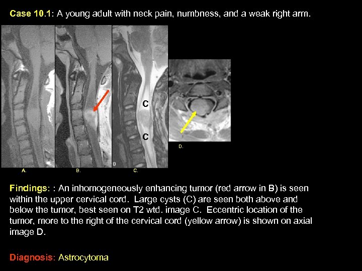 Case 10. 1: A young adult with neck pain, numbness, and a weak right
