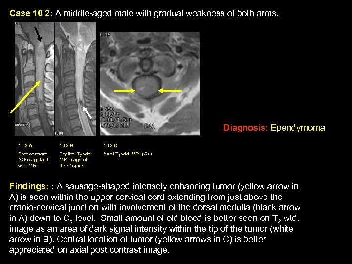 Case 10. 2: A middle-aged male with gradual weakness of both arms. Diagnosis: Ependymoma