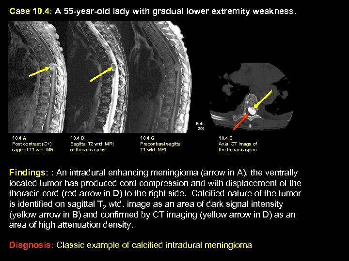 Case 10. 4: A 55 -year-old lady with gradual lower extremity weakness. 10. 4