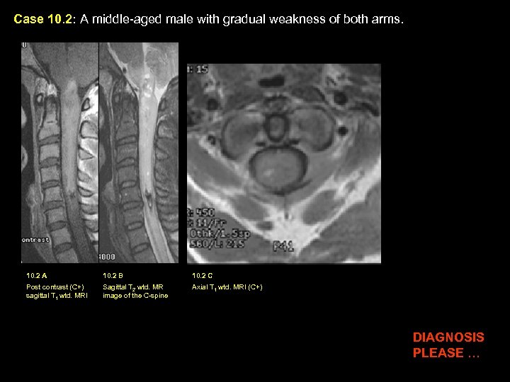 Case 10. 2: A middle-aged male with gradual weakness of both arms. 10. 2