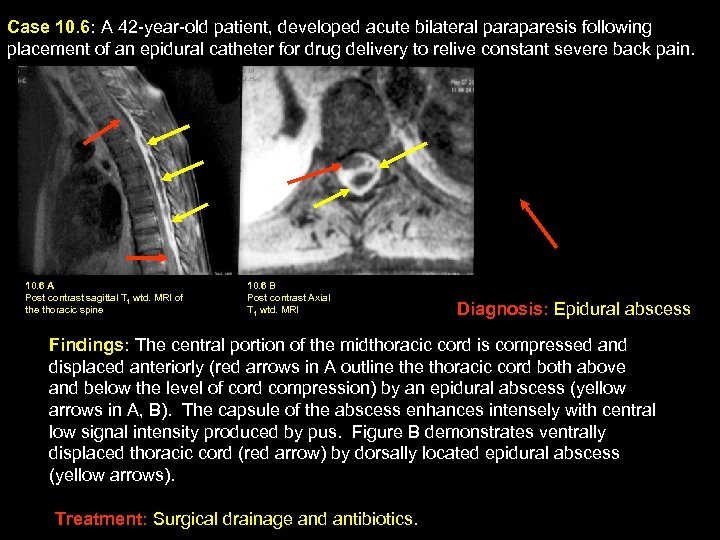 Case 10. 6: A 42 -year-old patient, developed acute bilateral paraparesis following placement of