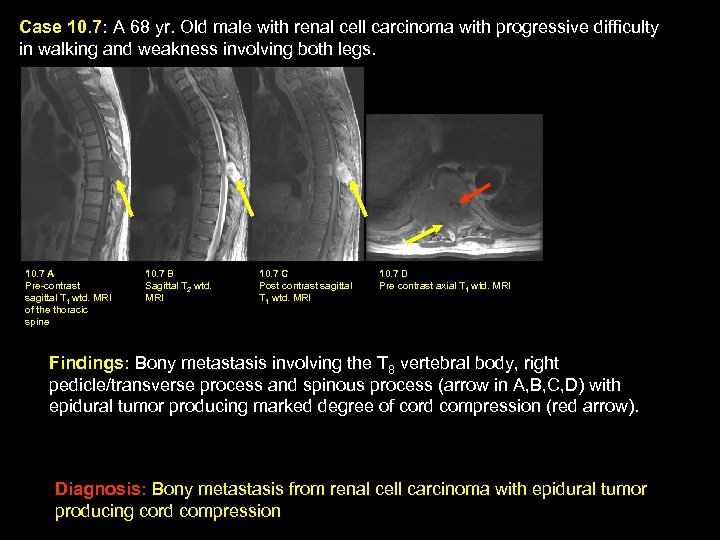 Case 10. 7: A 68 yr. Old male with renal cell carcinoma with progressive