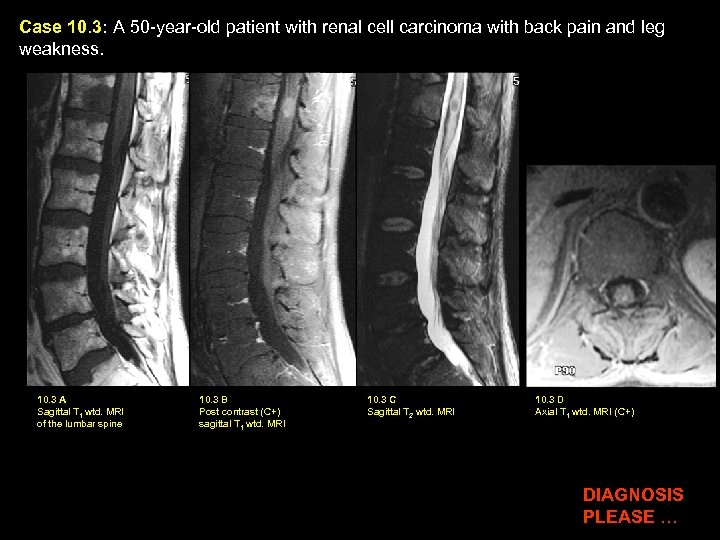 Case 10. 3: A 50 -year-old patient with renal cell carcinoma with back pain