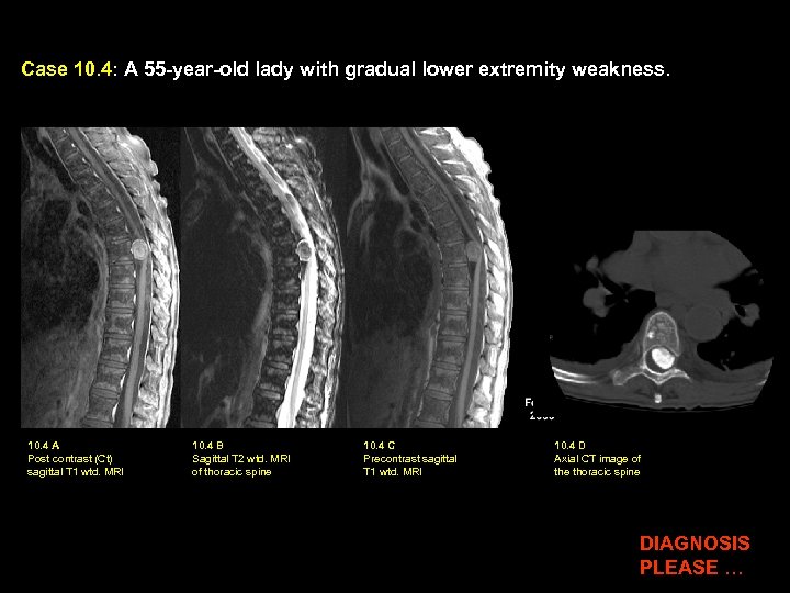 Case 10. 4: A 55 -year-old lady with gradual lower extremity weakness. 10. 4