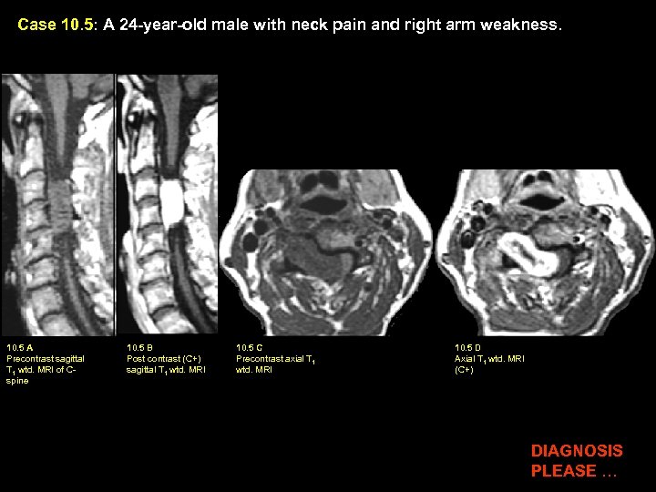 Case 10. 5: A 24 -year-old male with neck pain and right arm weakness.
