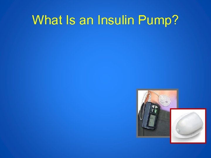 What Is an Insulin Pump? 