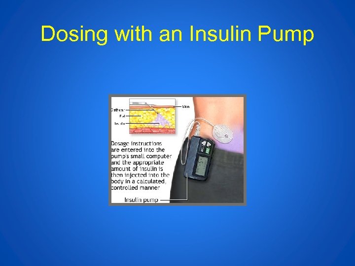 Dosing with an Insulin Pump 