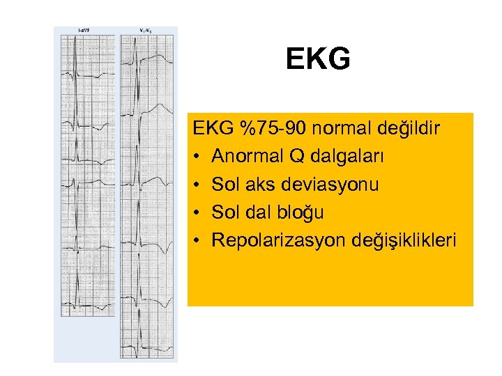 EKG %75 -90 normal değildir • Anormal Q dalgaları • Sol aks deviasyonu •