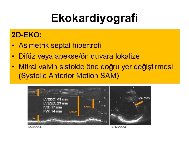Ekokardiyografi 2 D-EKO: • Asimetrik septal hipertrofi • Difüz veya apekse/ön duvara lokalize •