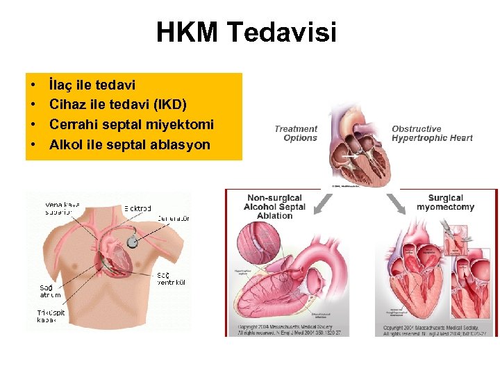 HKM Tedavisi • • İlaç ile tedavi Cihaz ile tedavi (IKD) Cerrahi septal miyektomi