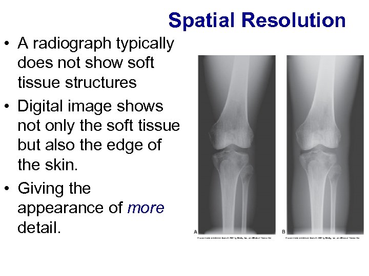 Spatial Resolution • A radiograph typically does not show soft tissue structures • Digital