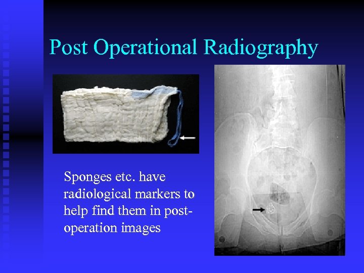 Post Operational Radiography Sponges etc. have radiological markers to help find them in postoperation