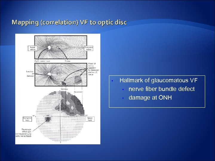 Mapping (correlation) VF to optic disc • Hallmark of glaucomatous VF • nerve fiber