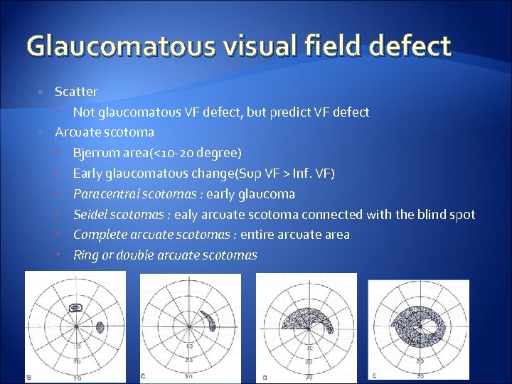 Glaucomatous visual field defect Scatter Not glaucomatous VF defect, but predict VF defect Arcuate