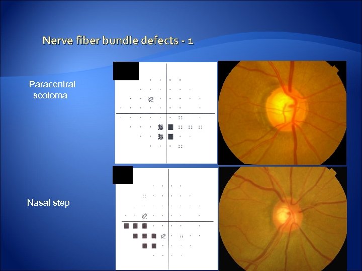 Nerve fiber bundle defects - 1 Paracentral scotoma Nasal step 