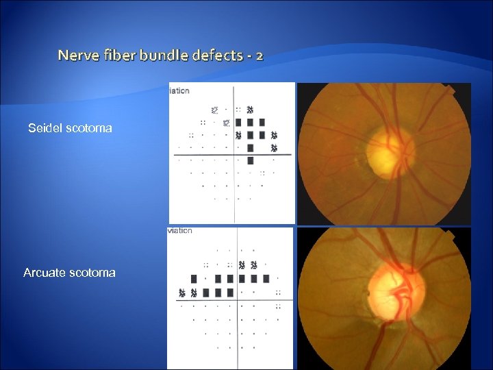 Nerve fiber bundle defects - 2 Seidel scotoma Arcuate scotoma 