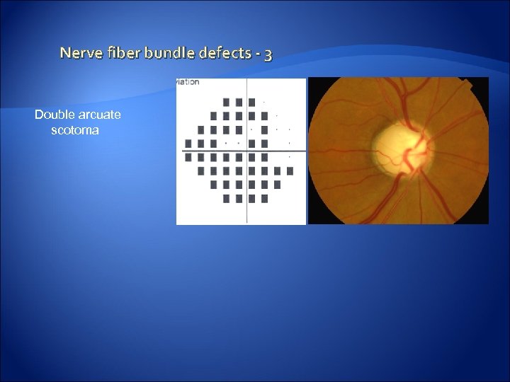 Nerve fiber bundle defects - 3 Double arcuate scotoma 