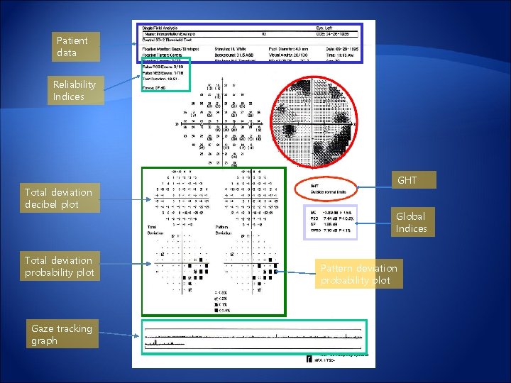 Patient data Reliability Indices Total deviation decibel plot Total deviation probability plot Gaze tracking