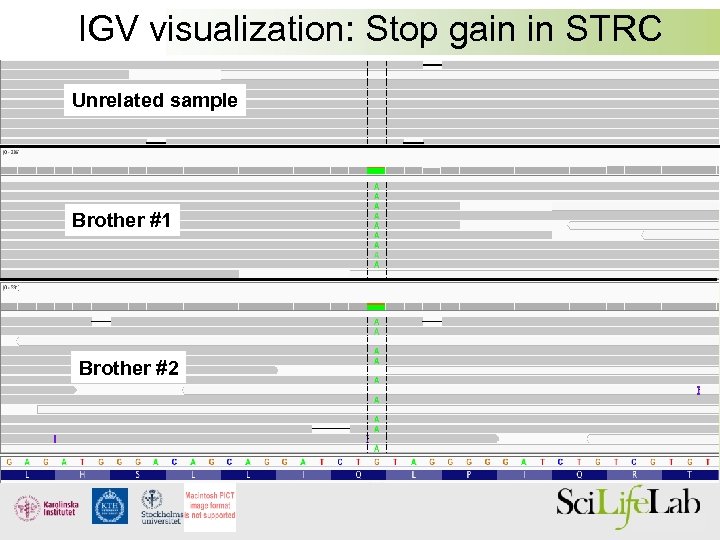 IGV visualization: Stop gain in STRC Unrelated sample Brother #1 Brother #2 