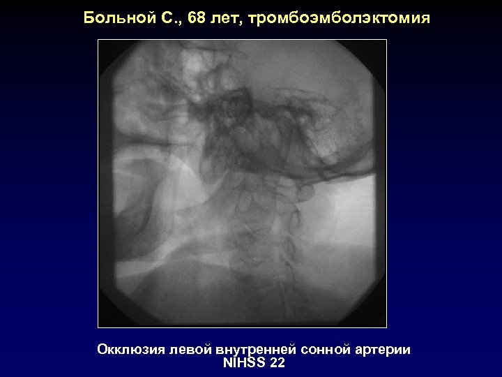 Больной С. , 68 лет, тромбоэмболэктомия Окклюзия левой внутренней сонной артерии NIHSS 22 