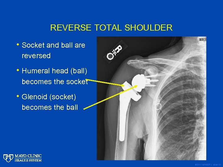 REVERSE TOTAL SHOULDER • Socket and ball are reversed • Humeral head (ball) becomes
