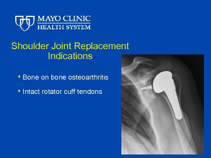 Shoulder Joint Replacement Indications • Bone on bone osteoarthritis • Intact rotator cuff tendons