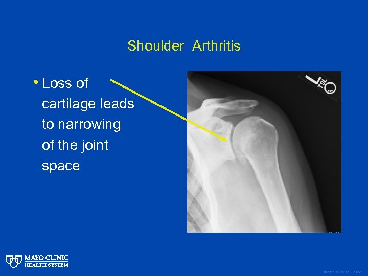 Shoulder Arthritis • Loss of cartilage leads to narrowing of the joint space ©