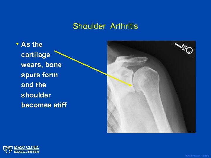 Shoulder Arthritis • As the cartilage wears, bone spurs form and the shoulder becomes
