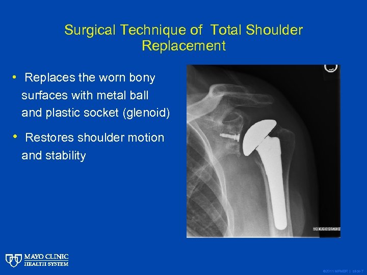 Surgical Technique of Total Shoulder Replacement • Replaces the worn bony surfaces with metal