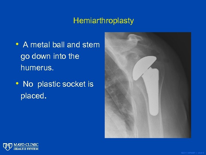 Hemiarthroplasty • A metal ball and stem go down into the humerus. • No