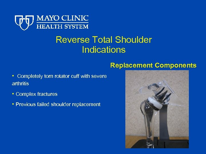 Reverse Total Shoulder Indications Replacement Components • Completely torn rotator cuff with severe arthritis