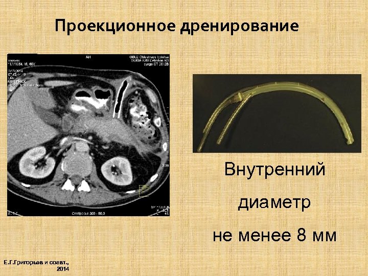 Проекционное дренирование Внутренний диаметр не менее 8 мм Е. Г. Григорьев и соавт. ,