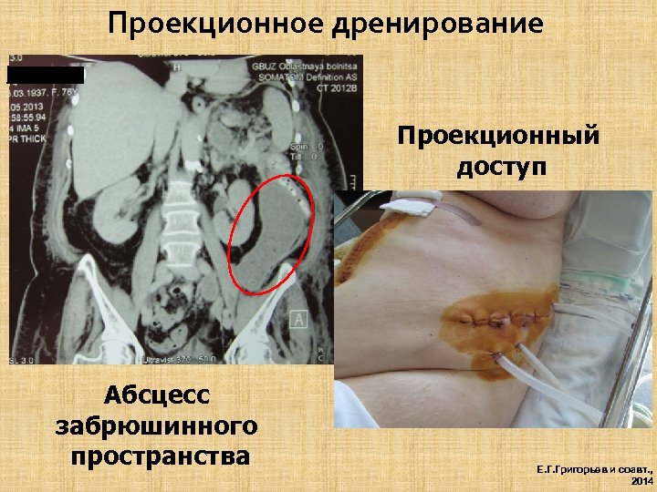 Проекционное дренирование Проекционный доступ Абсцесс забрюшинного пространства Е. Г. Григорьев и соавт. , 2014