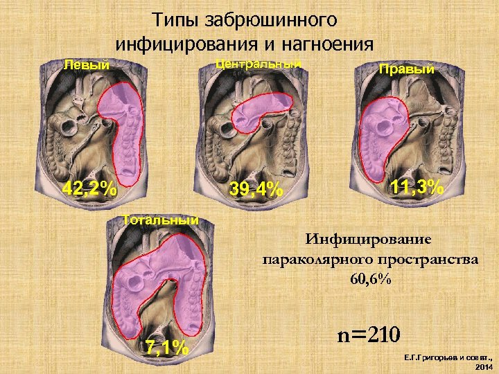Типы забрюшинного инфицирования и нагноения Левый Центральный 42, 2% 39, 4% Правый 11, 3%