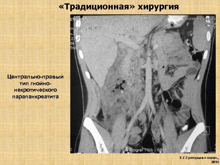  «Традиционная» хирургия Центрально-правый тип гнойнонекротического парапанкреатита Е. Г. Григорьев и соавт. , 2014