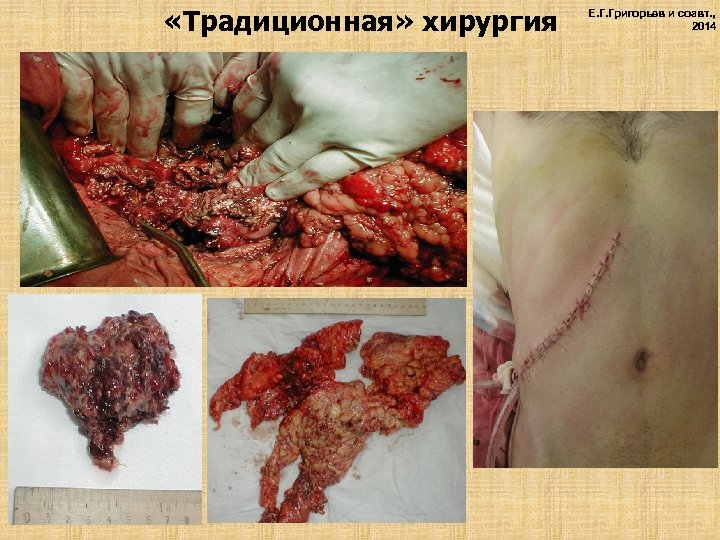  «Традиционная» хирургия Е. Г. Григорьев и соавт. , 2014 