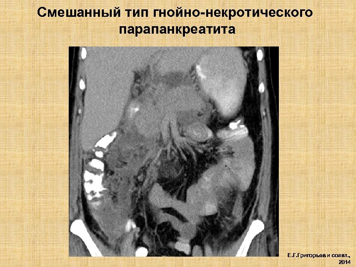 Смешанный тип гнойно-некротического парапанкреатита Е. Г. Григорьев и соавт. , 2014 