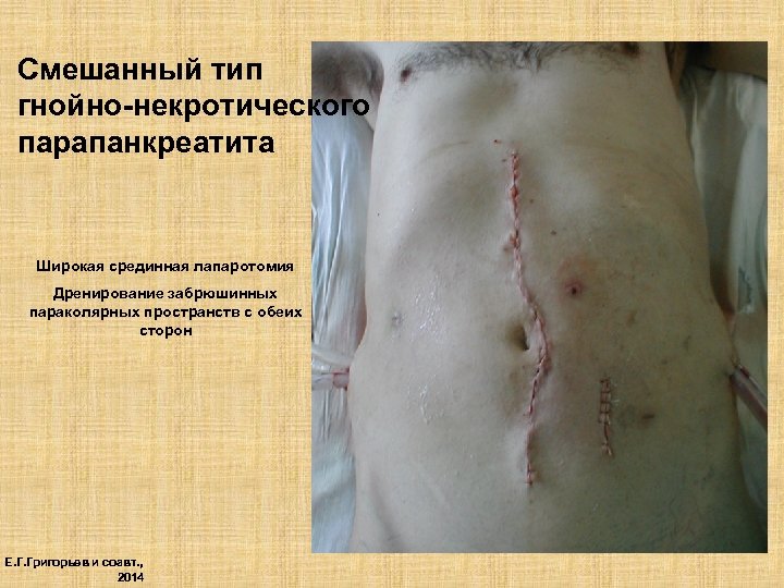 Смешанный тип гнойно-некротического парапанкреатита Широкая срединная лапаротомия Дренирование забрюшинных параколярных пространств с обеих сторон