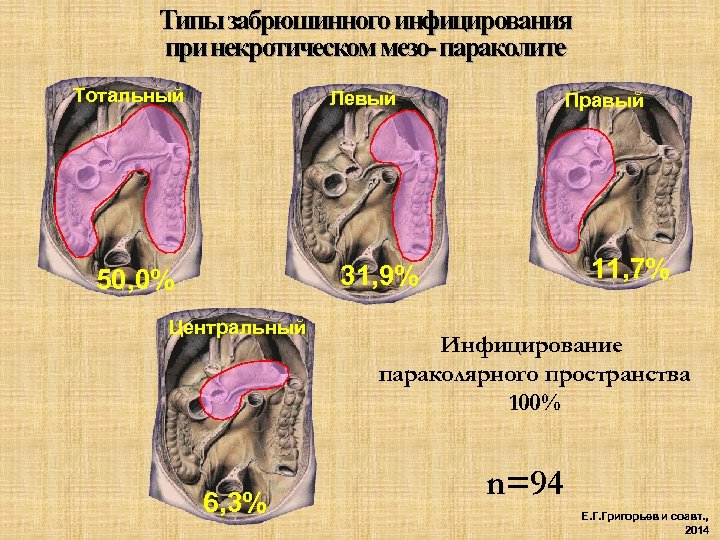 Типы забрюшинного инфицирования при некротическом мезо- параколите Тотальный Левый Правый 11, 7% 31, 9%