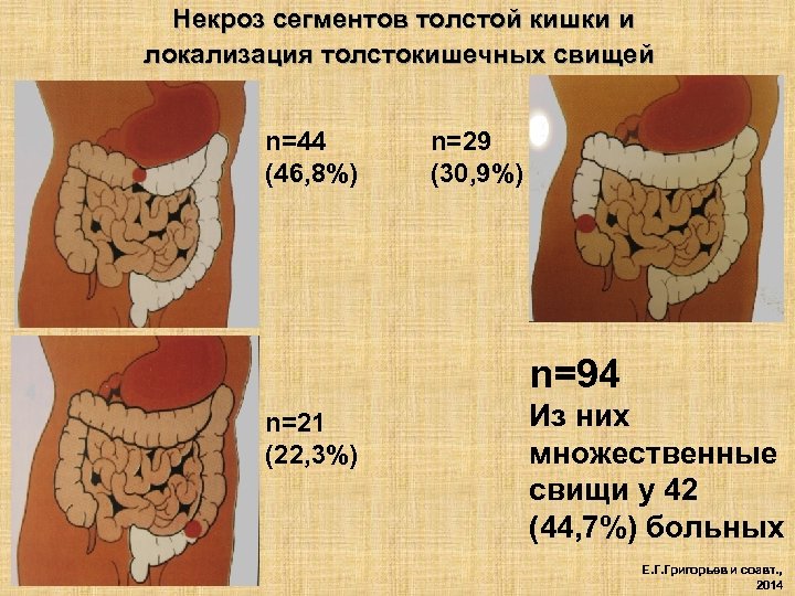 Некроз сегментов толстой кишки и локализация толстокишечных свищей n=44 (46, 8%) n=29 (30, 9%)