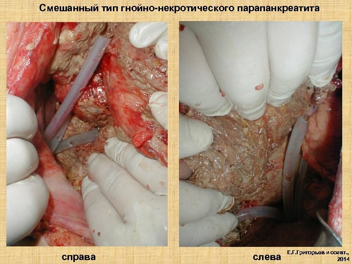 Смешанный тип гнойно-некротического парапанкреатита справа слева Е. Г. Григорьев и соавт. , 2014 