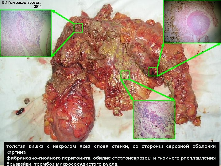 Е. Г. Григорьев и соавт. , 2014 толстая кишка с некрозом всех слоев стенки,