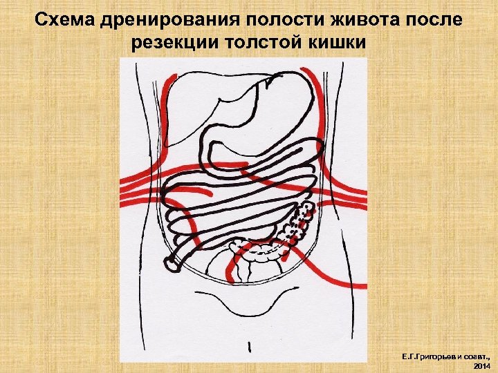 Схема дренирования полости живота после резекции толстой кишки Е. Г. Григорьев и соавт. ,